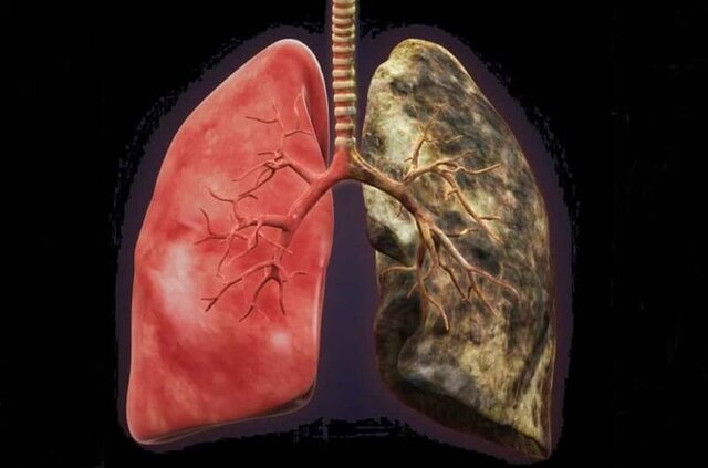 این علائم نشان دهنده آسیب “ریه” در سیگاری‌ها است