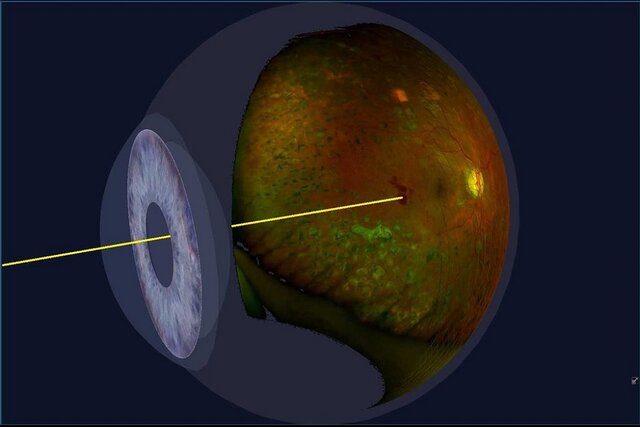 تولید گاز برای جراحی‌های شبکیه چشم در کشور/۸ سال انتظار برای صدور مجوزها